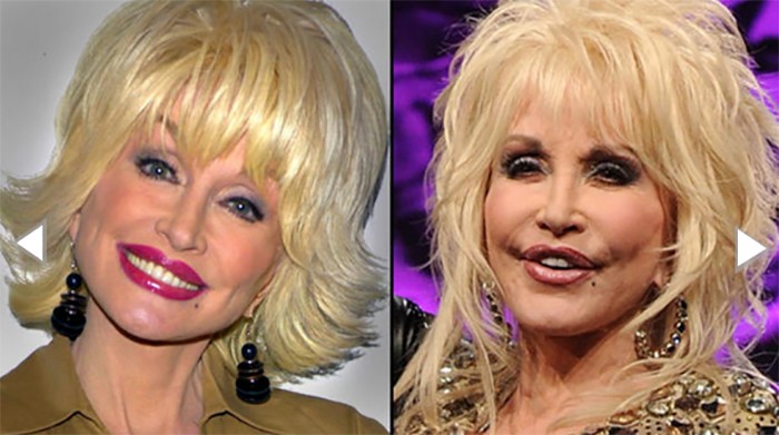 Top 10 Most Drastic Plastic Surgeries Gone Wrong for our Most Favorite