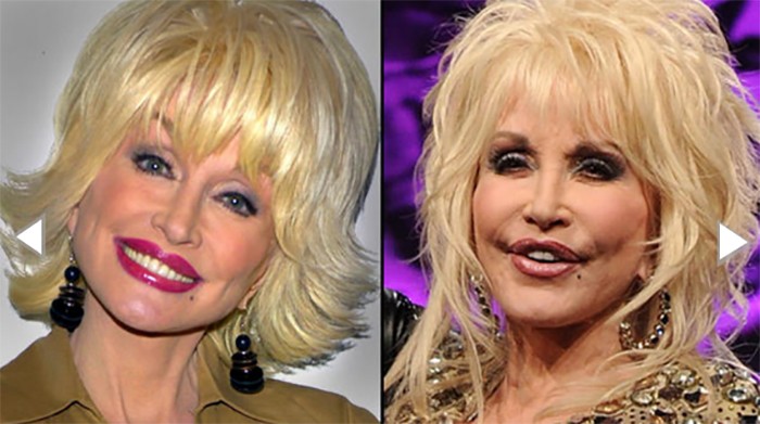 Top 10 Most Drastic Plastic Surgeries Gone Wrong for our ...